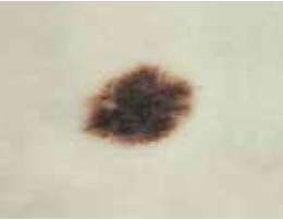 Picture of melanoma skin cancer