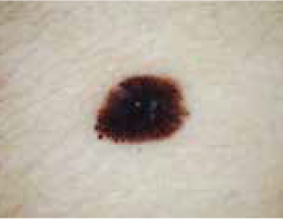 Picture of melanoma skin cancer