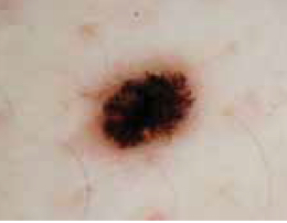 Picture of melanoma skin cancer