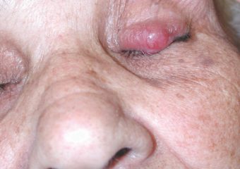 Merkel cell carcinoma on senior woman left eyelid