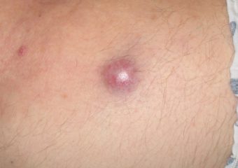 Merkel cell carcinoma