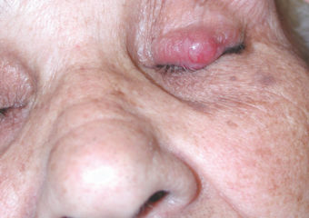 Picture merkel cell carcinoma on woman's left eyelid