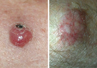 Merkel cell carcinomas