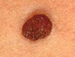 Grain De Beauter Oeil Santé Médecine