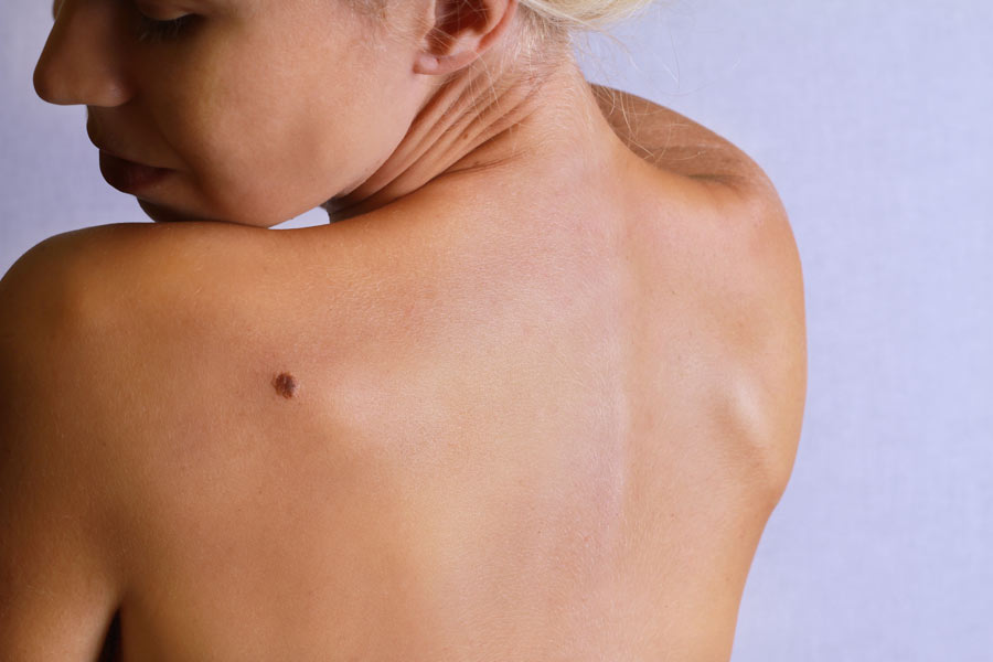 Ask the Expert: Painful Moles - The Skin Cancer Foundation