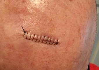 stitches after Mohs Surgery on forehead for squamous cell carcinoma