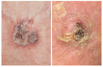 Squamous cell carcinoma scaly patch